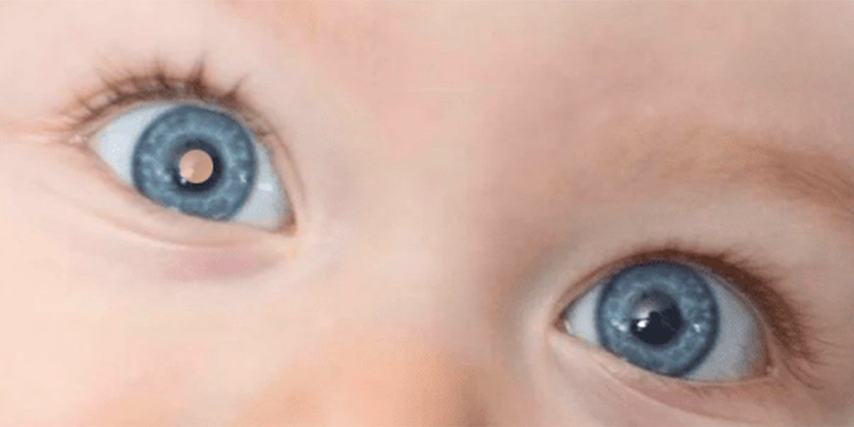 Imagem mostra reflexo em olho de criança. Teste é feito para identificar o retinoblastoma