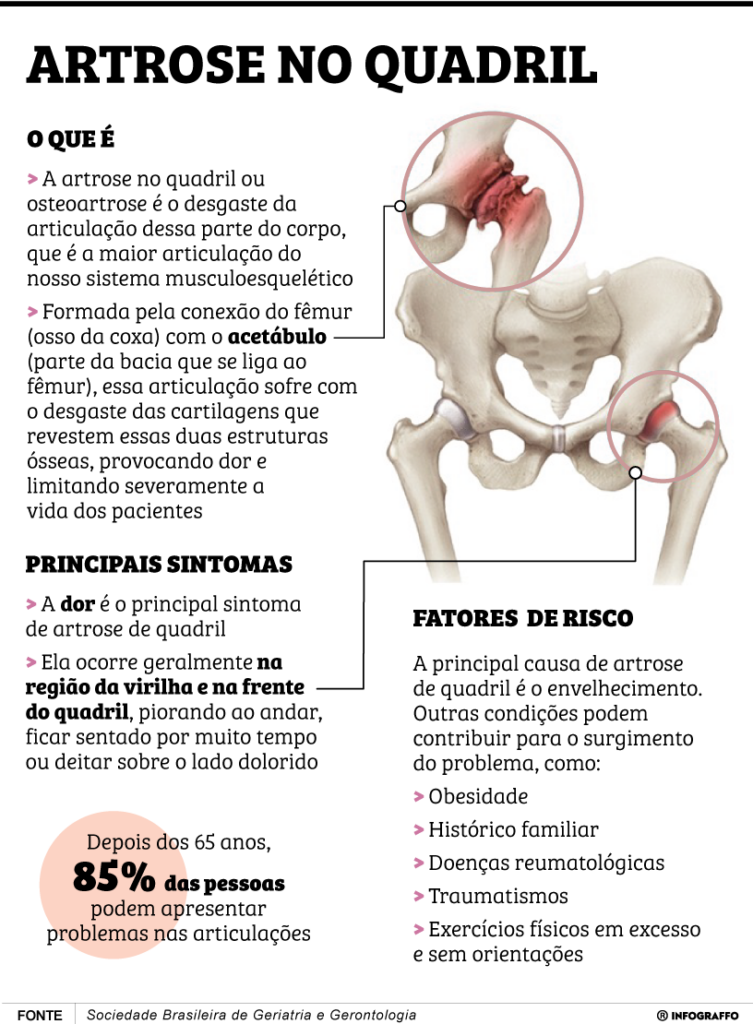 Artrose no quadril