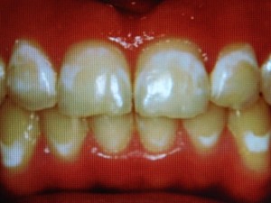 manchas-brancas-dentes-aparelho-2