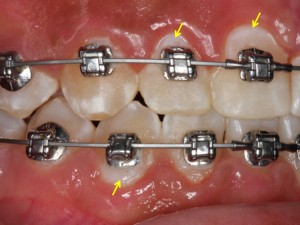 manchas-brancas-dentes-aparelho-3