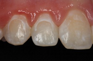 manchas-brancas-dentes-aparelho-4