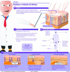 vitiligo