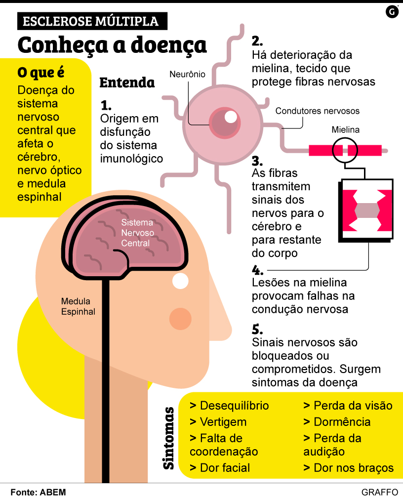 6 sintomas iniciais e surpreendentes da Esclerose Múltipla