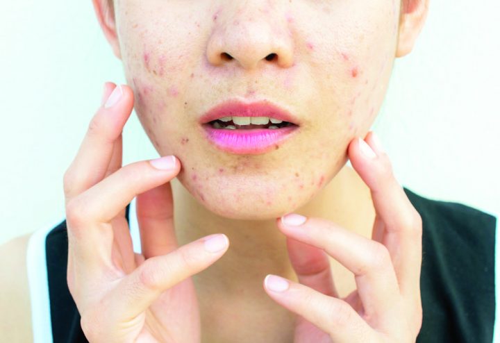 Dermatologista alerta para o aparecimento de acnes, especialmente entre quem tem pele oleosa. (Foto: Reprodução internet).