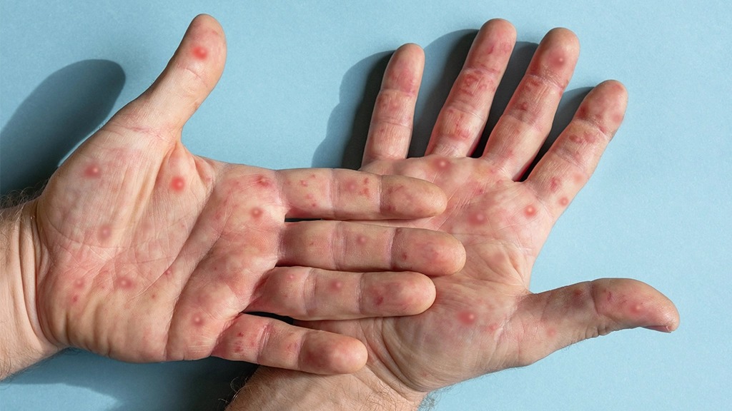 Mpox já infectou 140 pessoas no Brasil em 2026; saiba quais os sintomas