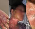 Mulher sofre queimaduras apÃ³s peeling e clÃ­nica Ã© condenada no ParanÃ¡
